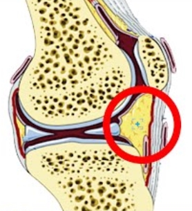 Location of the fat pad underneath the knee cap