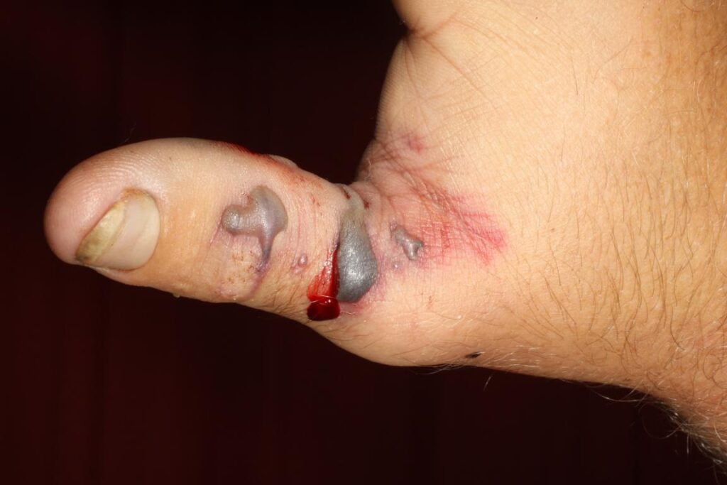 Puff adder bite on a thumb after one hour