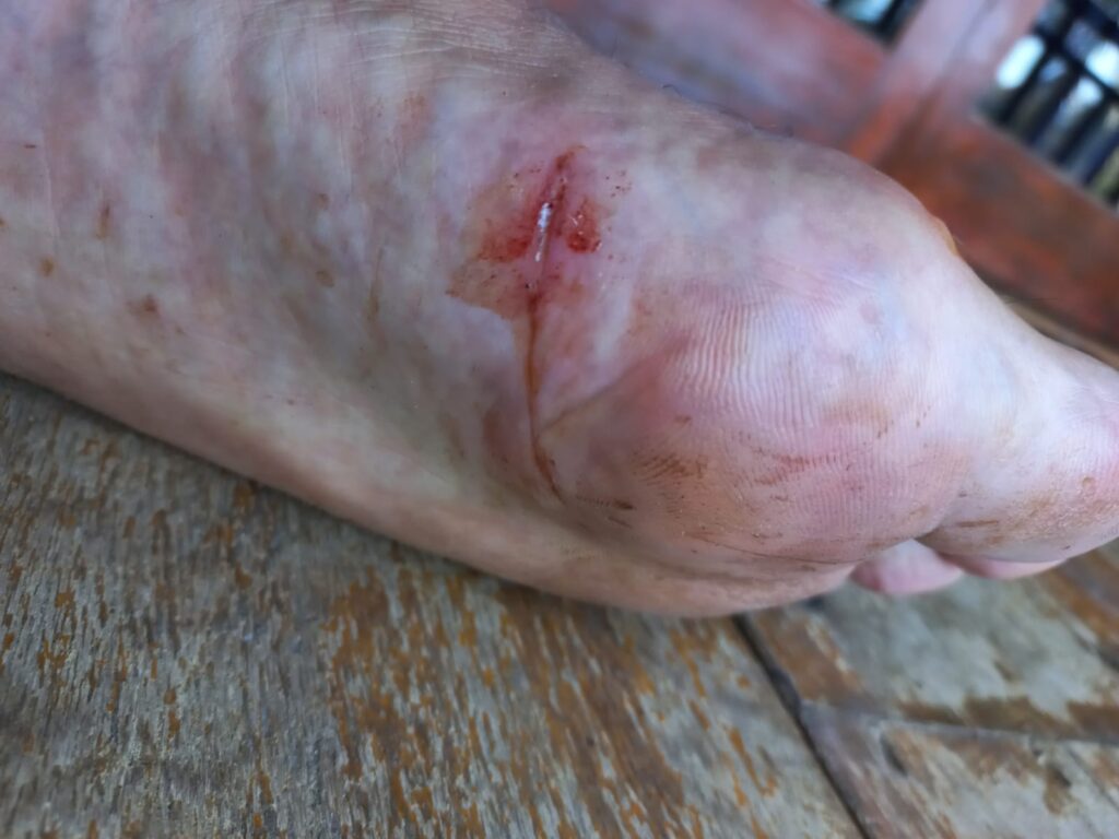 Cut in foot from rattan thorns