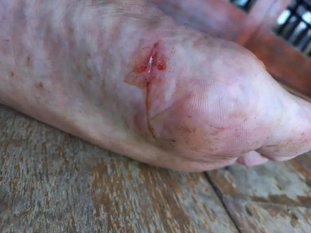 Cut on the foot sole by rattan thorns due to a lack of jungle footwear