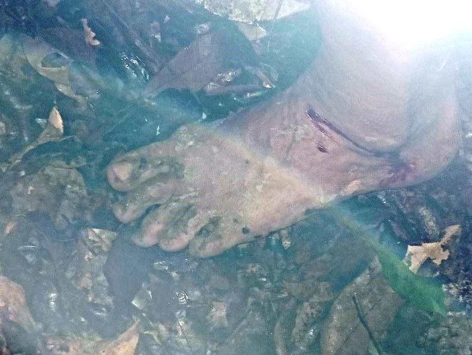 Bleeding after multipe bites of leeches in the rainforest